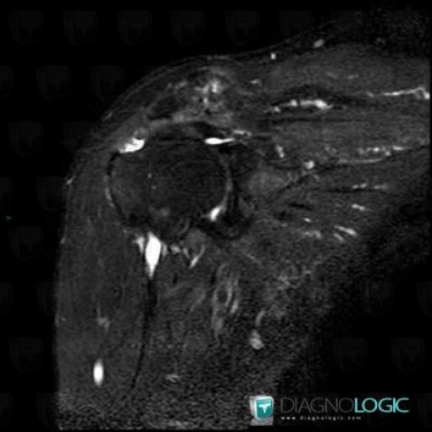 Rotator cuff tears, Supraspinatus tendon, MRI