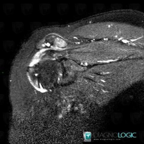 Rotator cuff tears, Supraspinatus tendon, MRI