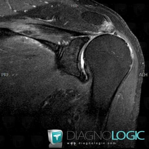Rotator cuff tears, Supraspinatus tendon, MRI
