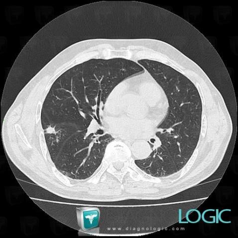 Round pneumonia, Pulmonary parenchyma, CT