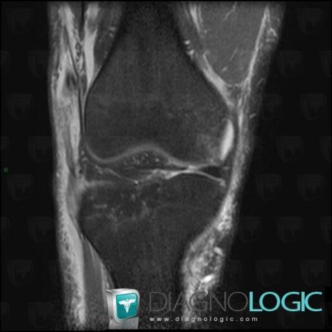 Rupture de-bandelette ilio tibiale, Tractus iléo tibial, IRM