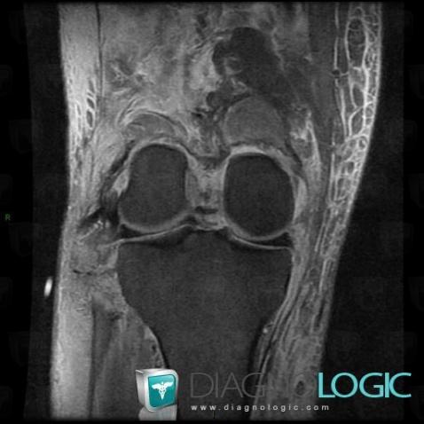 Rupture-ligament collatéral latéral / Genou, Ligament collateral latéral - Genou, IRM