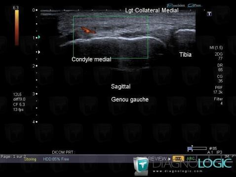 Rupture-ligament collatéral médial, Ligament collatéral médial - Genou, Echographie