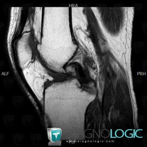 Rupture-ligament croisé antérieur, Ligament croisé antérieur, IRM
