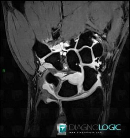 Rupture-ligament scapho lunaire, Autres parties molles/nerfs - Poignet, IRM