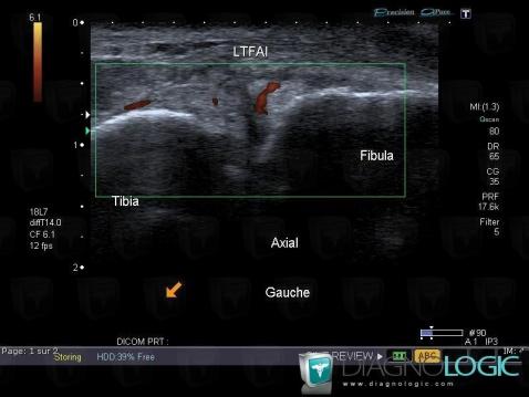 Rupture-ligament tibio-fibulaire antéro-inférieur, Autres ligaments - Cheville, Echographie