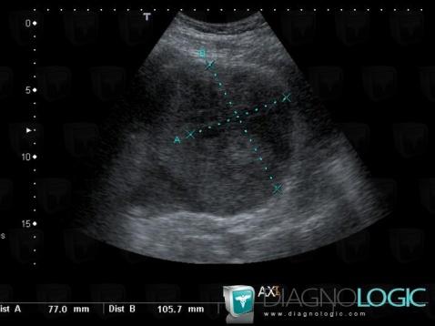 Rupture splénique, Rate, Echographie
