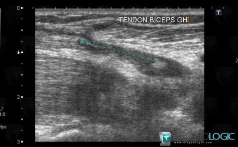 Rupture-tendon-biceps brachial, Tendon-biceps - Coude, Echographie