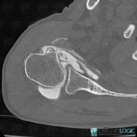 Rupture-tendons de-coiffe-rotateurs, Tendon sub scapulaire, Scanner