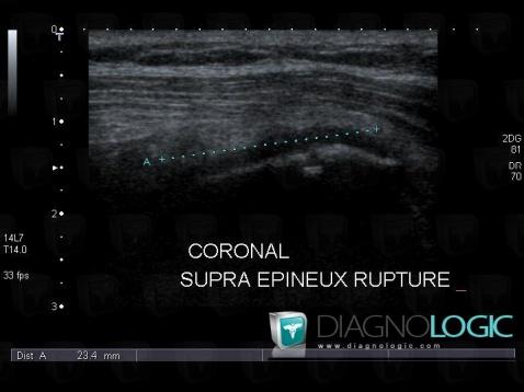 Rupture-tendons de-coiffe-rotateurs, Tendon supra épineux, Echographie