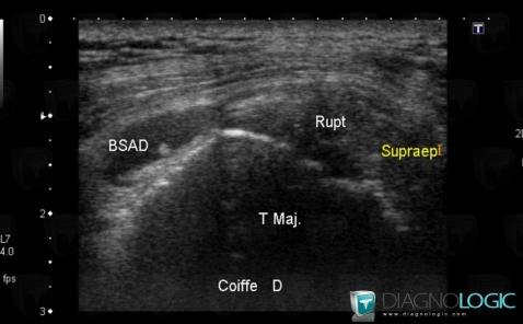 Rupture-tendons de-coiffe-rotateurs, Tendon supra épineux, Echographie