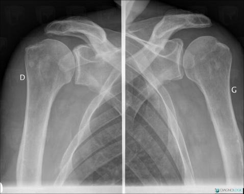 Rupture-tendons de-coiffe-rotateurs, Tendon supra épineux, Radio