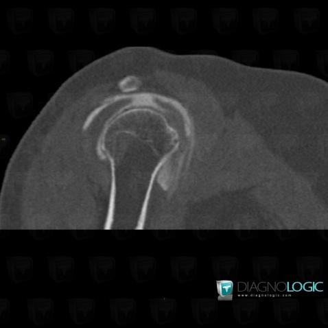 Rupture-tendons de-coiffe-rotateurs, Tendon supra épineux, Scanner