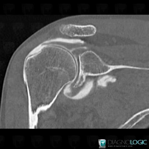 Rupture-tendons de-coiffe-rotateurs, Tendon supra épineux, Scanner