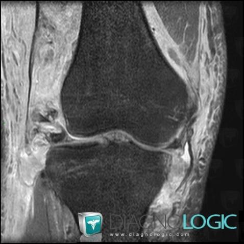 Rupture-the Iliotibial tract, Ileo tibial tract, MRI