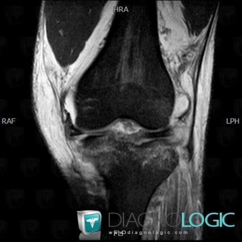 Rupture-the Iliotibial tract, Ileo tibial tract, MRI