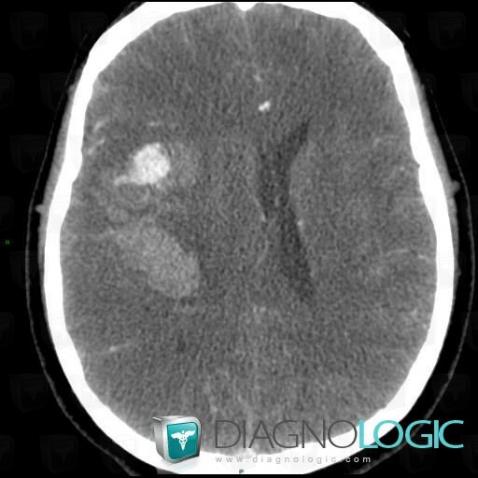 Ruptured aneurysm, Cerebral arteries, CT