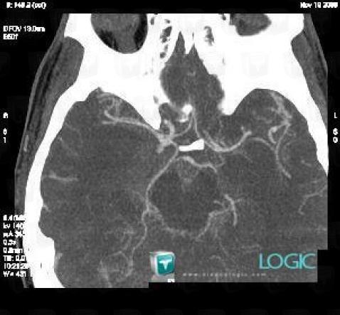 Ruptured aneurysm, Willis polygon, CT