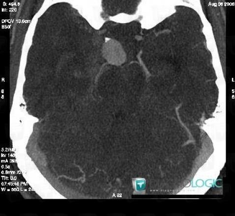 Ruptured aneurysm, Willis polygon, CT