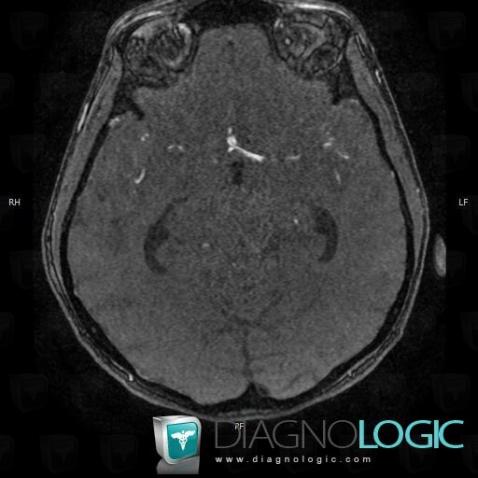 Ruptured aneurysm, Willis polygon, MRI