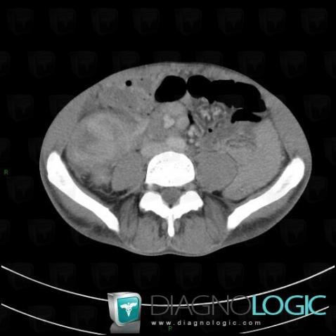 Salmonella colitis, Colon, CT