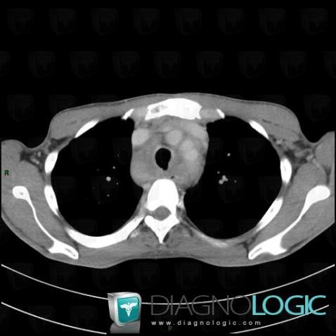 Salmonellosis, Mediastinum, CT