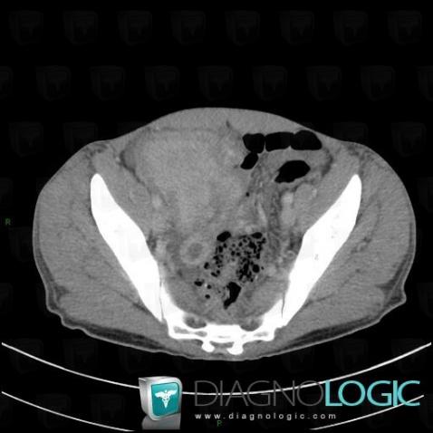 Salmonellosis, Small bowel, CT