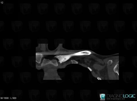 SAPHO syndrome, Clavicle, CT