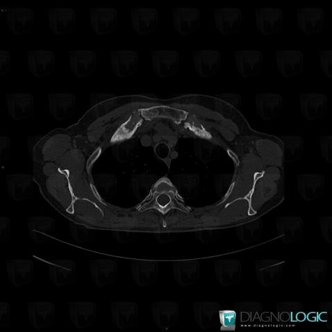 SAPHO syndrome, Costosternal / Sternoclavicular joint and Costal cartilage, CT