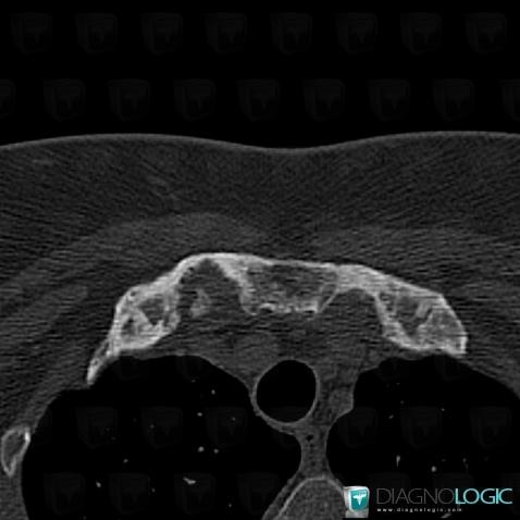 SAPHO syndrome, Costosternal / Sternoclavicular joint and Costal cartilage, CT