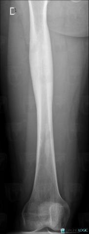 SAPHO syndrome, Femur - Mid part, X rays