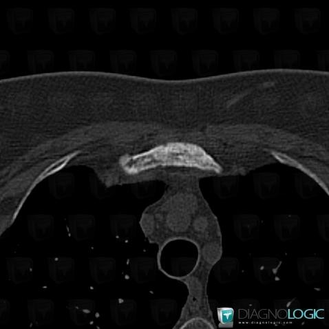 SAPHO syndrome, Sternum, CT