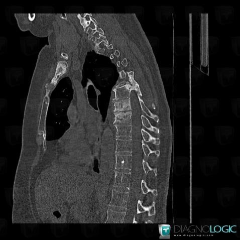 SAPHO syndrome, Vertebral body / Disk, CT