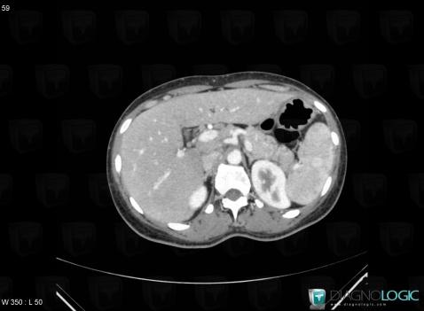 Sarcoïdose, Foie, Rate, Scanner