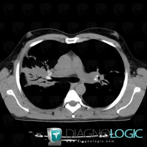 Sarcoïdose, Médiastin, Scanner