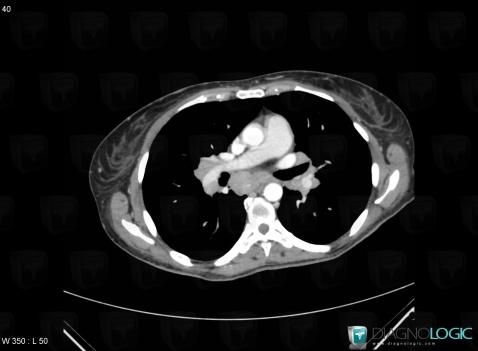 Sarcoïdose, Médiastin, Scanner