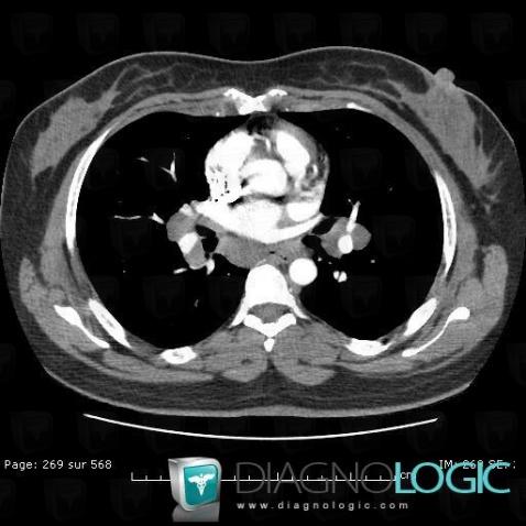 Sarcoïdose, Médiastin, TDM