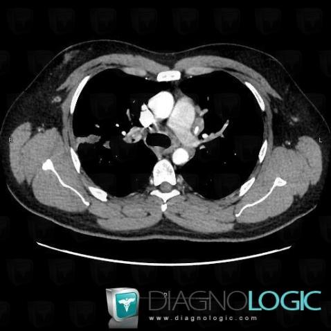 Sarcoïdose, Médiastin, TDM