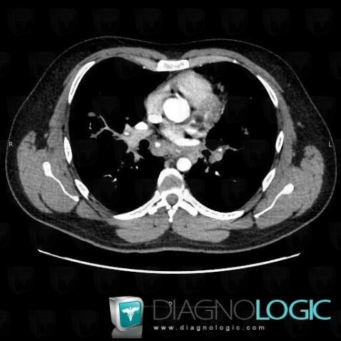 Sarcoïdose, Médiastin, TDM