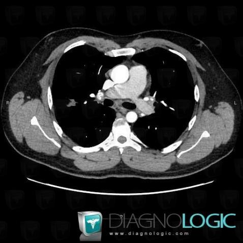 Sarcoïdose, Médiastin, TDM