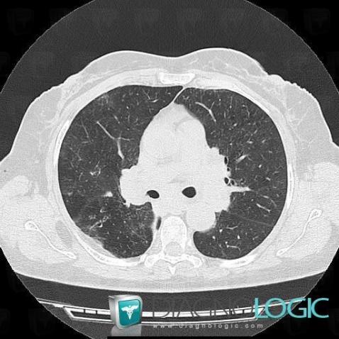 Sarcoïdose, Parenchyme pulmonaire, Scanner