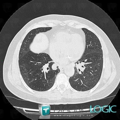 Sarcoïdose, Parenchyme pulmonaire, Scanner