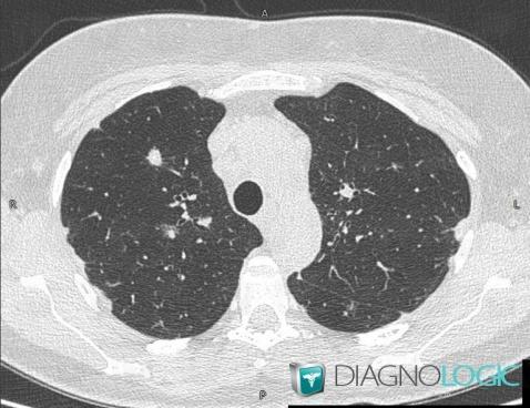 Sarcoïdose, Parenchyme pulmonaire, Scanner