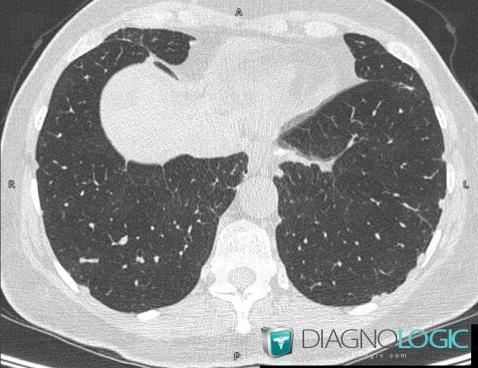 Sarcoïdose, Parenchyme pulmonaire, Scanner