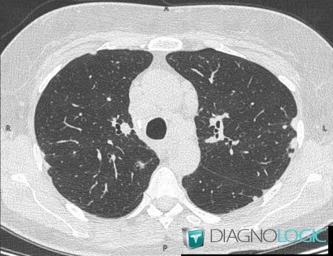 Sarcoïdose, Parenchyme pulmonaire, Scanner