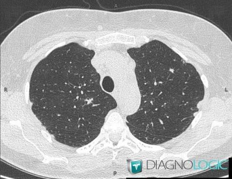Sarcoïdose, Parenchyme pulmonaire, Scanner