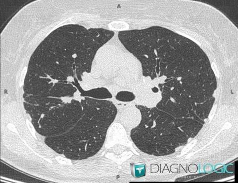 Sarcoïdose, Parenchyme pulmonaire, Scanner