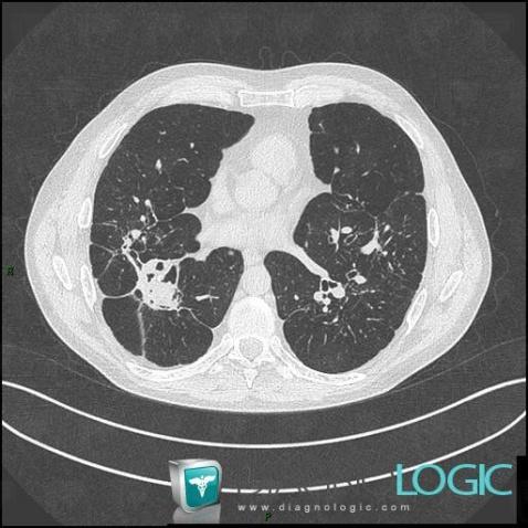 Sarcoïdose, Parenchyme pulmonaire, Scanner