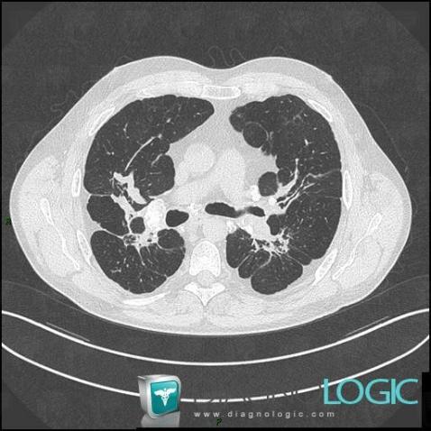 Sarcoïdose, Parenchyme pulmonaire, Scanner