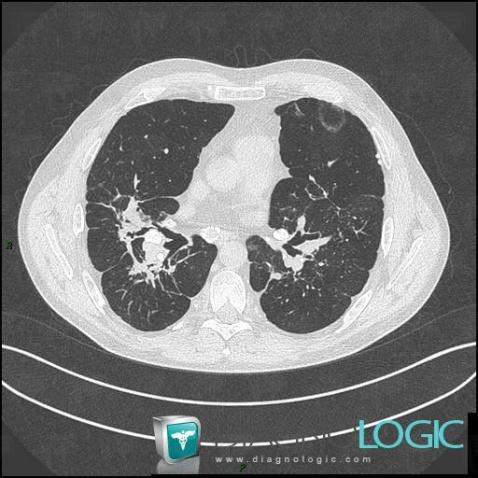 Sarcoïdose, Parenchyme pulmonaire, Scanner